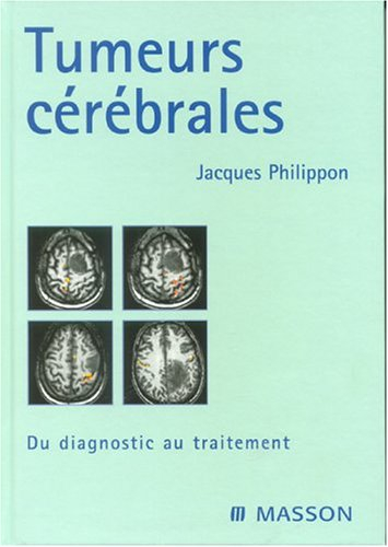 Tumeurs cérébrales : du diagnostic au traitement