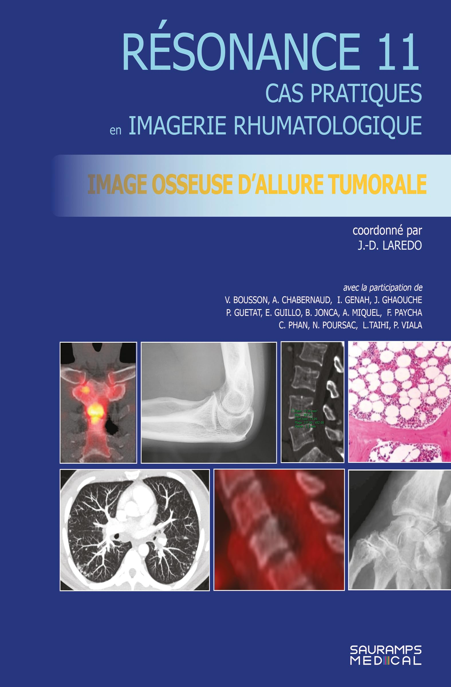 Résonance : cas pratiques en imagerie rhumatologique. Vol. 11. Image osseuse d'allure tumorale