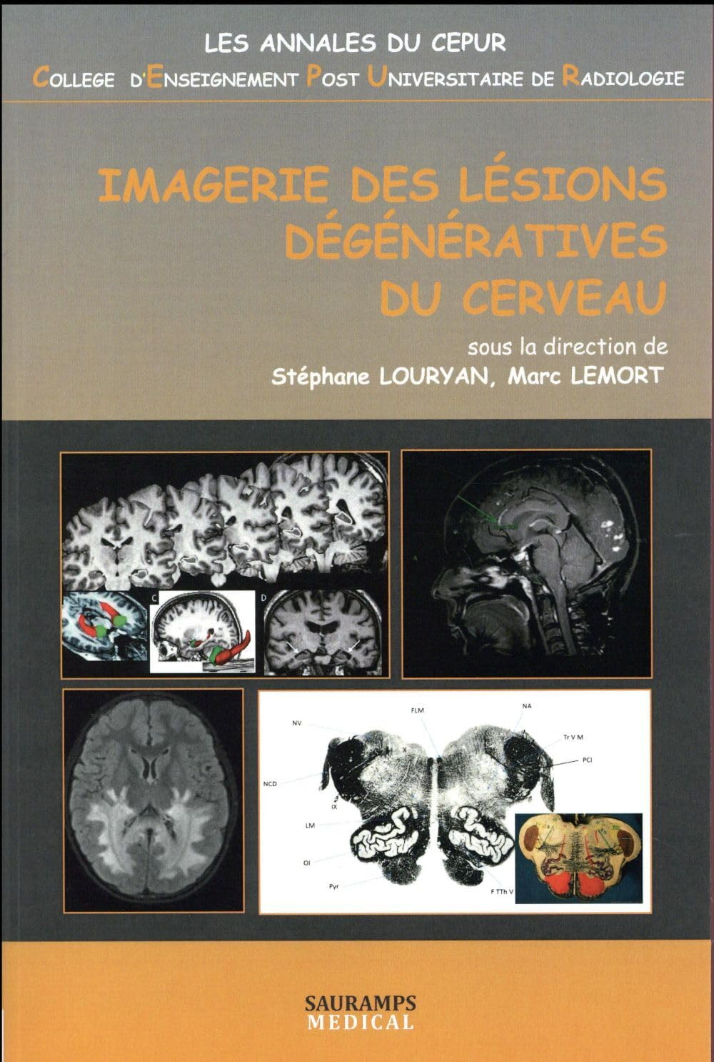 Imagerie des lésions dégénératives du cerveau