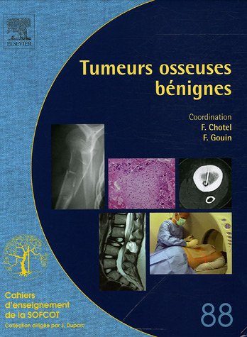 Tumeurs osseuses bénignes