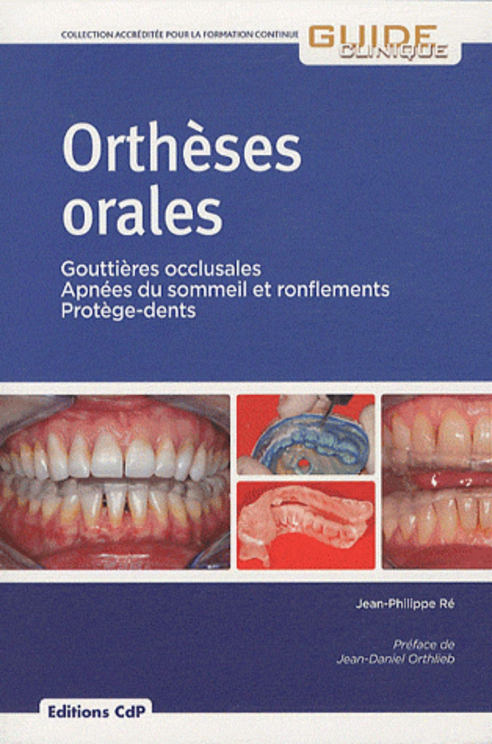 Orthèses orales : gouttières occlusales, apnées du sommeil et ronflements, protège-dents