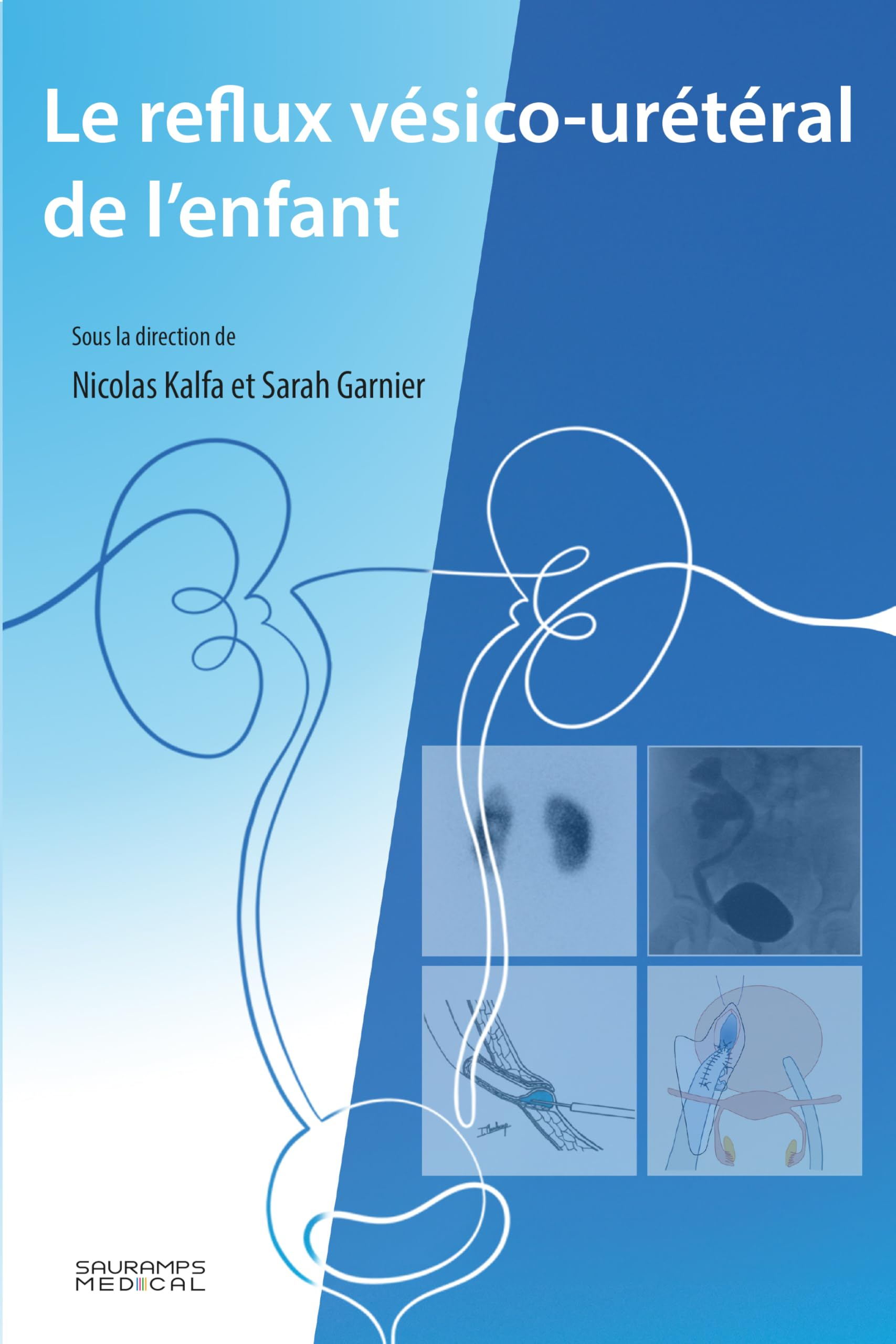 Le reflux vésico-urétéral de l'enfant