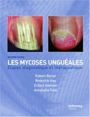Onychomycosis/Les Mycoses Ungueales: Etapes Diagnostique Et Clinique