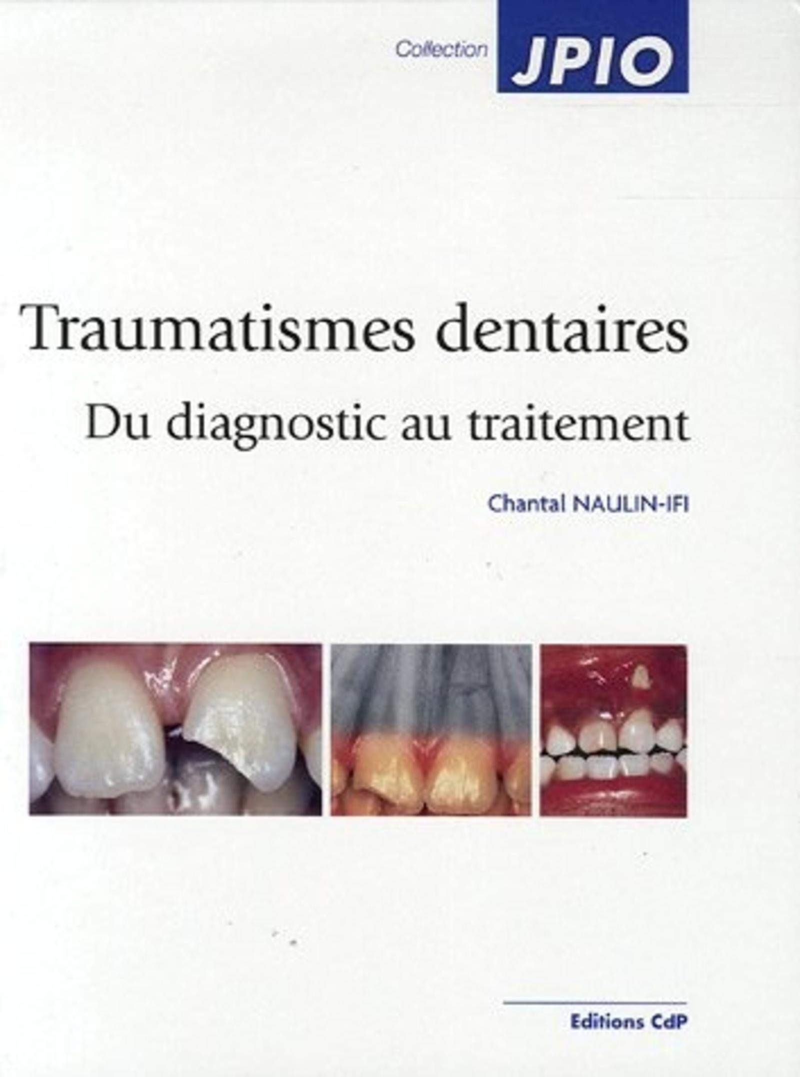 Traumatismes dentaires : du diagnostic au traitement